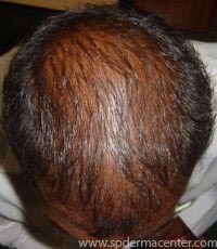 Hair After 3 months
